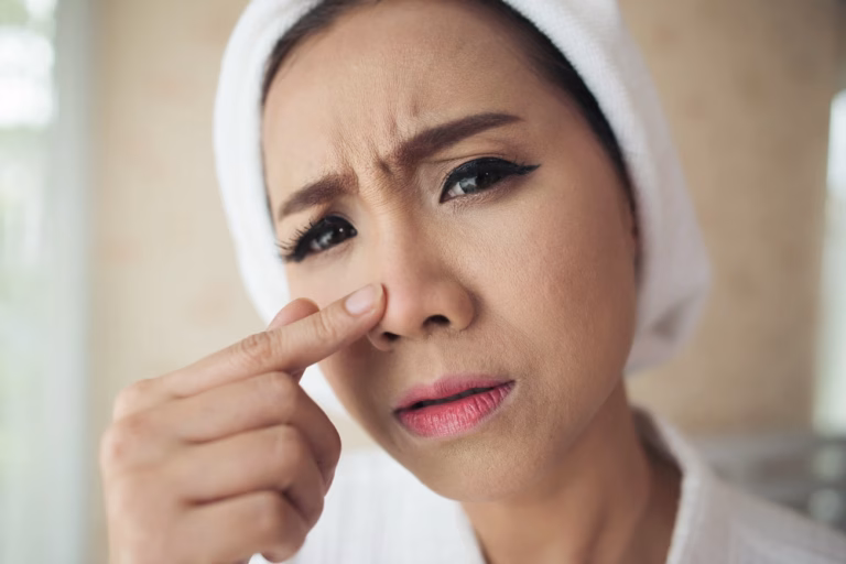 Komedo Hitam (Blackheads): Penyebab, Gejala, dan Cara Mencegahnya